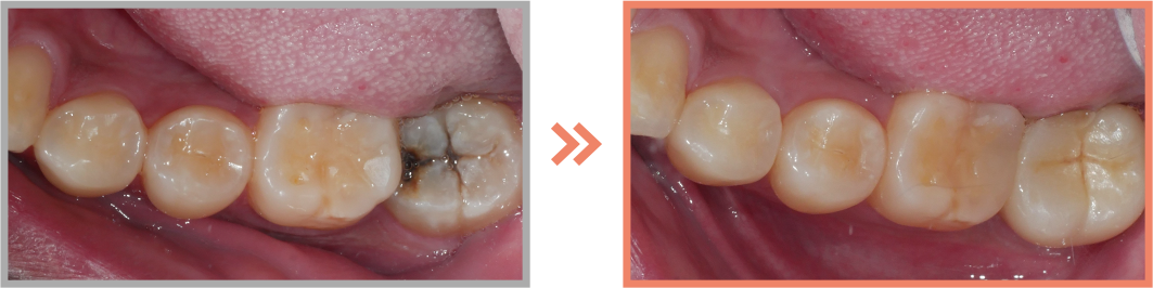 충치치료 증례05