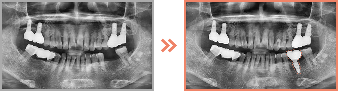 임플란트 증례01
