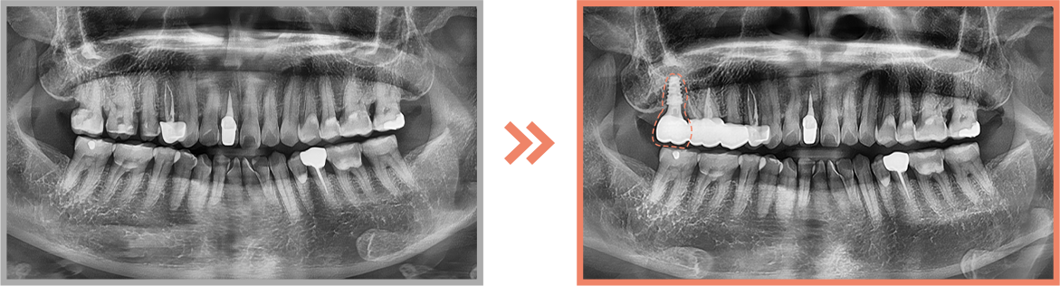 임플란트 증례03