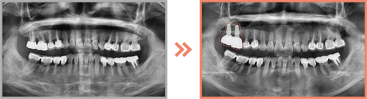 임플란트 증례04