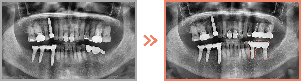 임플란트 증례05