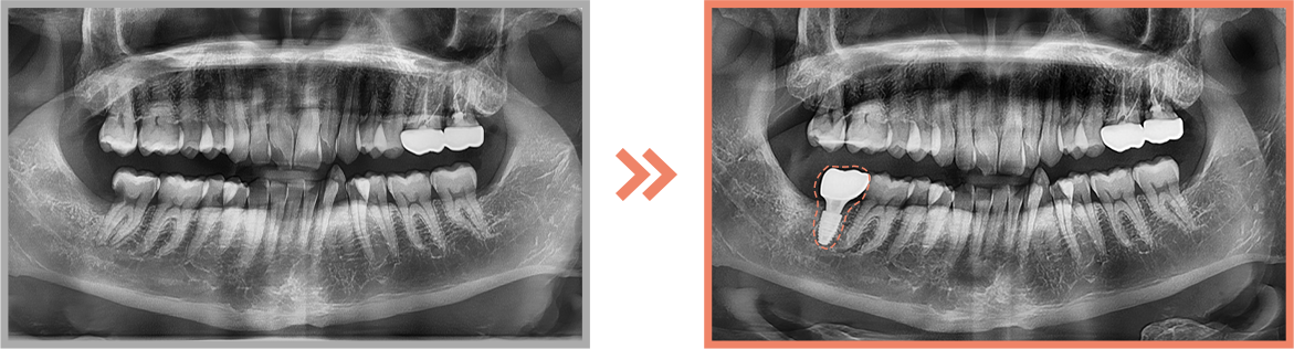 임플란트 증례06