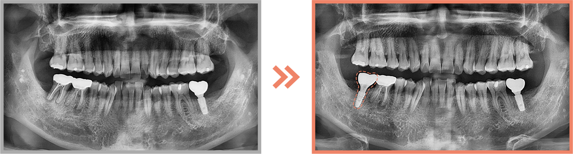 임플란트 증례07