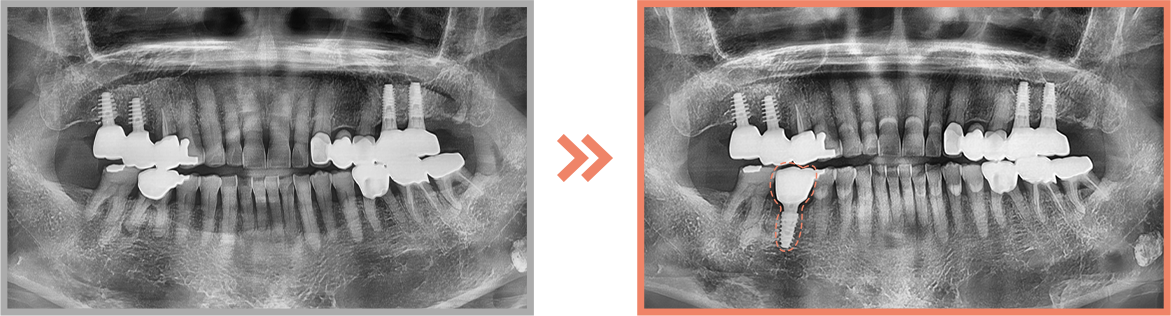 임플란트 증례08
