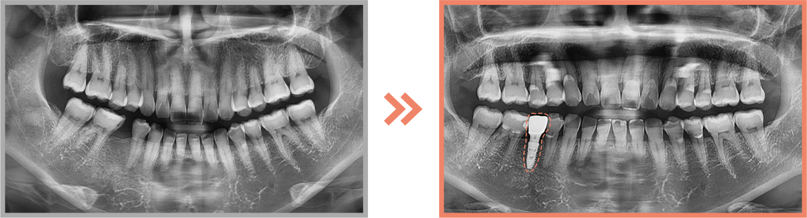 임플란트 증례09
