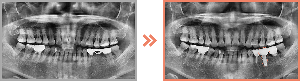 임플란트 증례10
