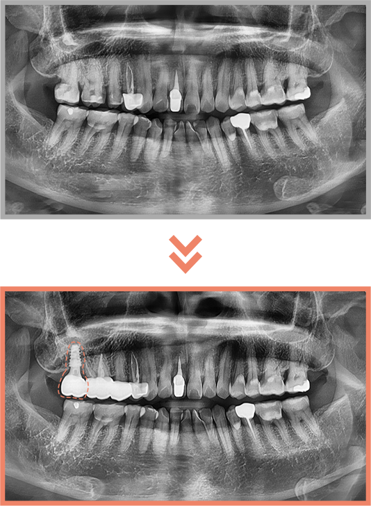 임플란트 증례03