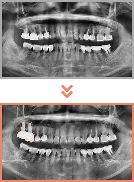 임플란트 증례04