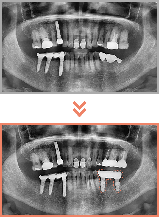 임플란트 증례05