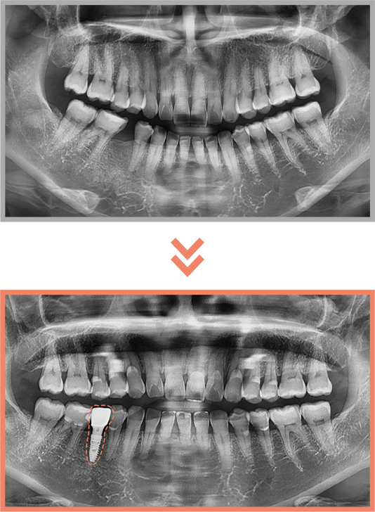 임플란트 증례09