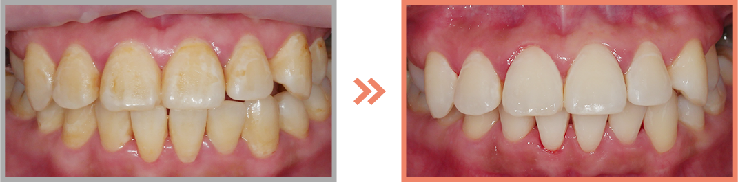 치아미백 증례01