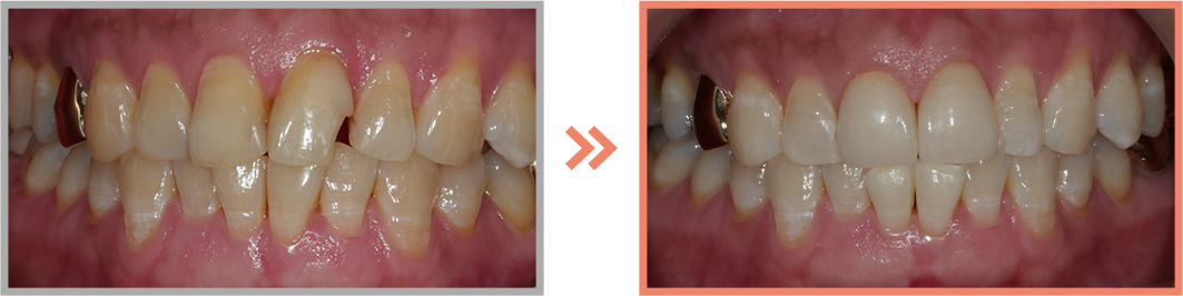 치아미백 증례02