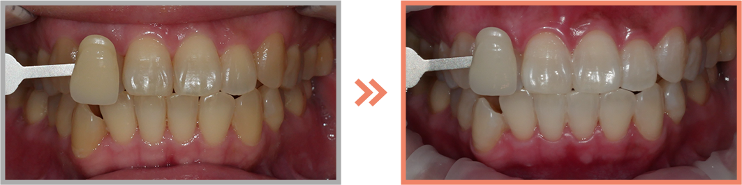 치아미백 증례03