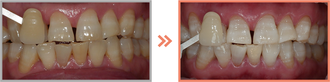 치아미백 증례04