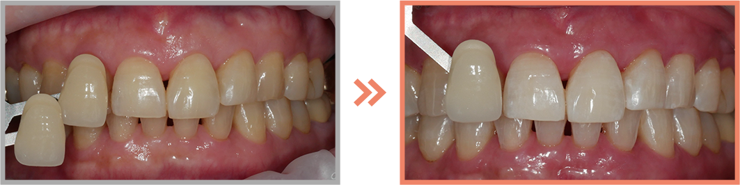치아미백 증례05