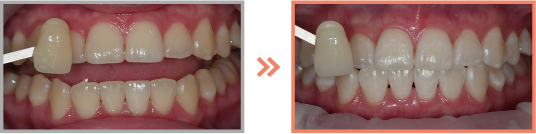 치아미백 증례06