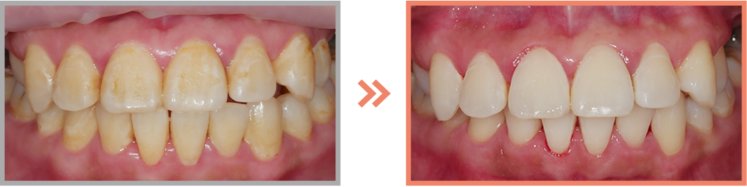 치아미백 증례07