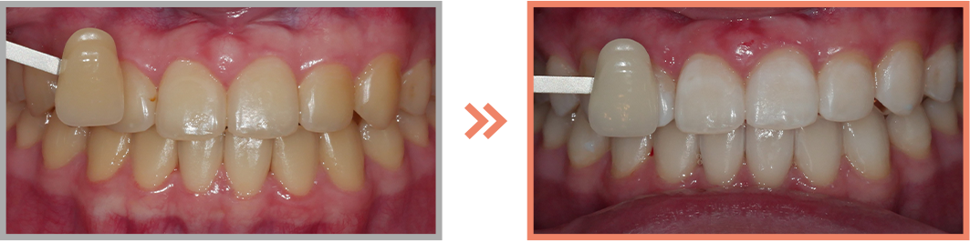 치아미백 증례08