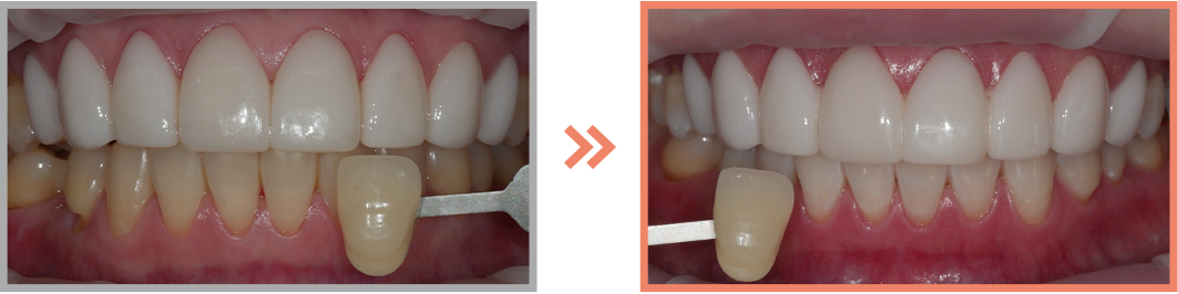 치아미백 증례09
