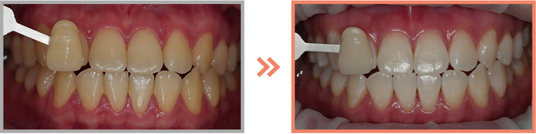 치아미백 증례10