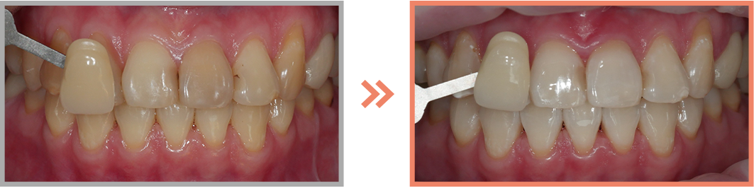 치아미백 증례11