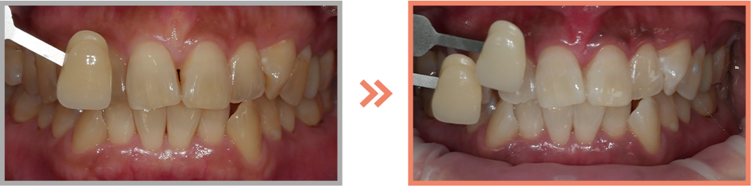 치아미백 증례12