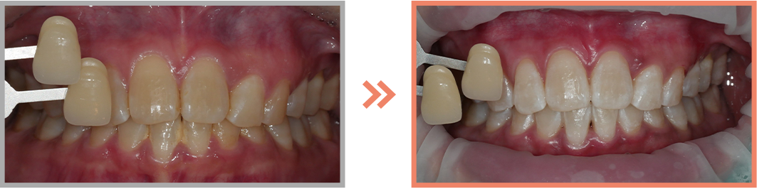 치아미백 증례13