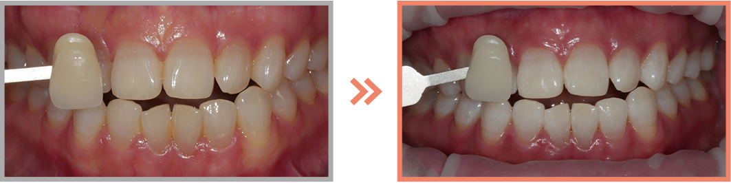 치아미백 증례14