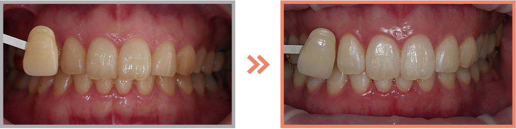치아미백 증례15