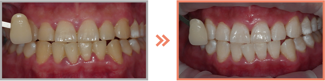 치아미백 증례16