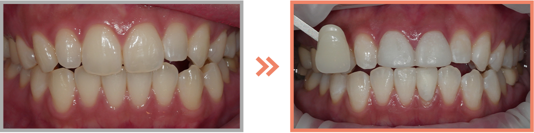 치아미백 증례17