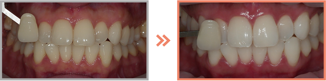 치아미백 증례18