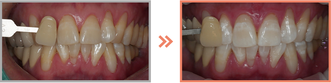 치아미백 증례19