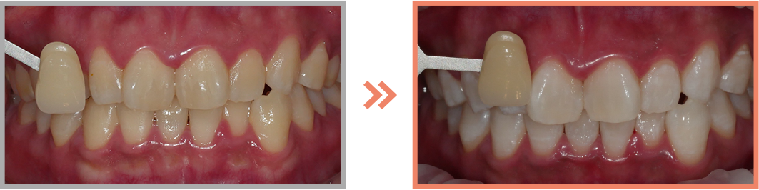 치아미백 증례20