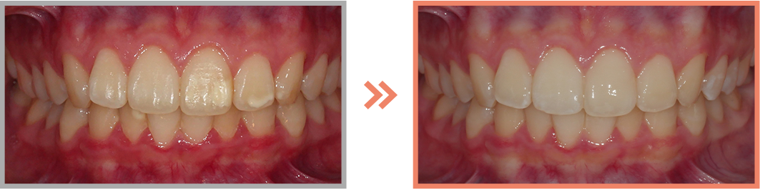 치아미백 증례21
