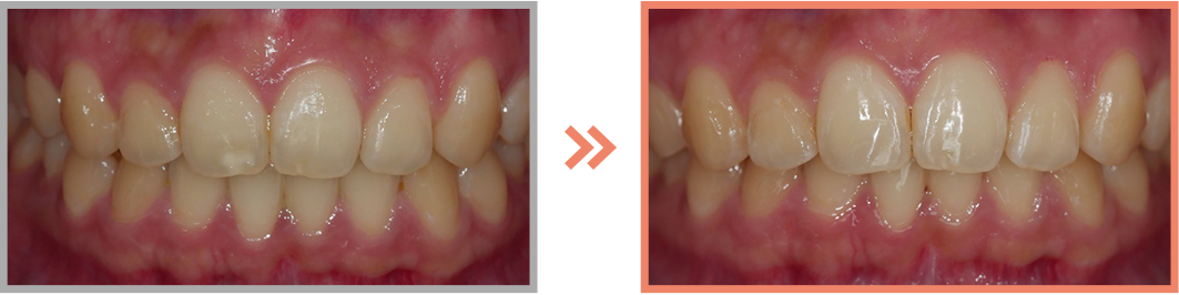치아미백 증례22