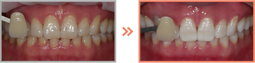 치아미백 증례23