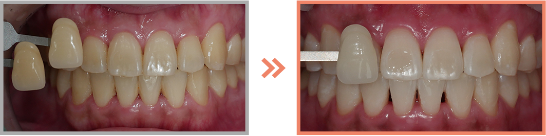 치아미백 증례24