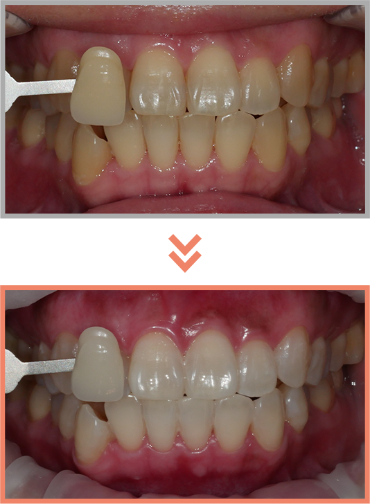 치아미백 증례03