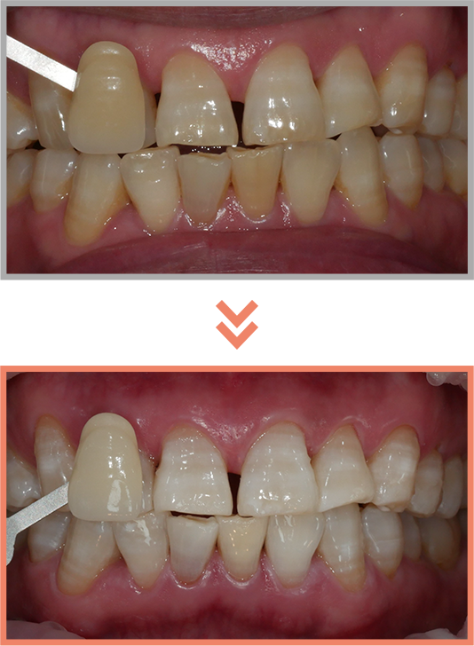 치아미백 증례04