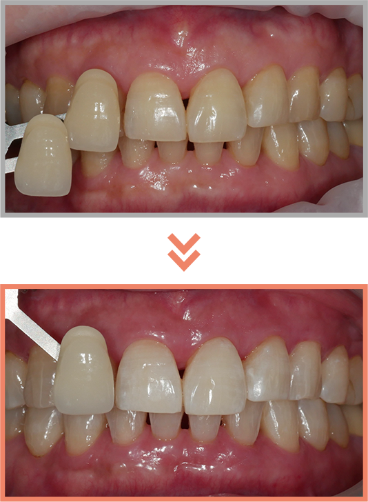 치아미백 증례05