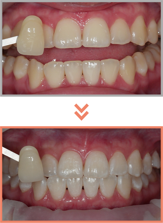 치아미백 증례06