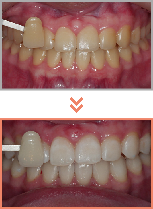 치아미백 증례08
