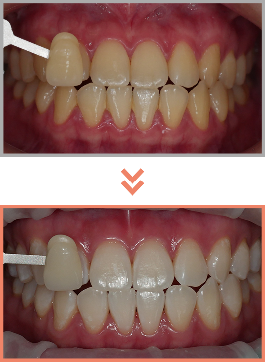 치아미백 증례10