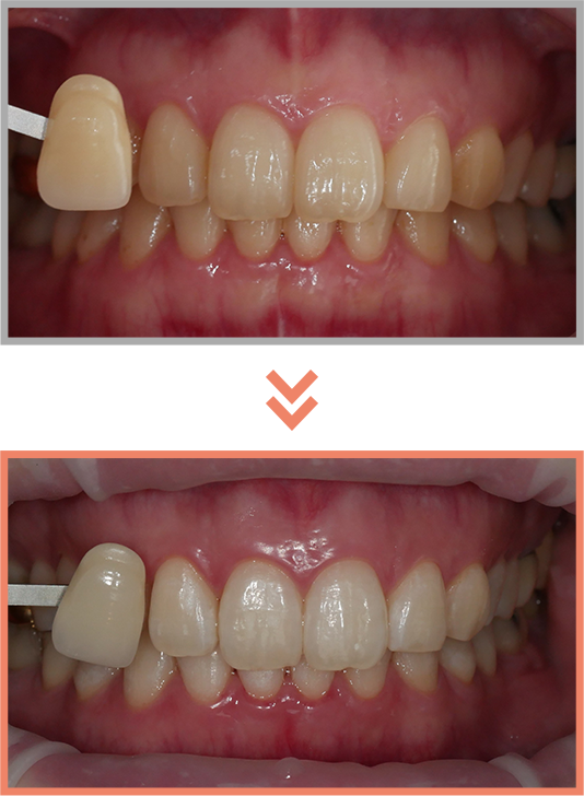 치아미백 증례15