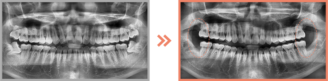 사랑니 발치 증례01
