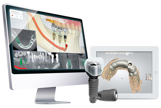 컴퓨터 분석을 이용한 임플란트