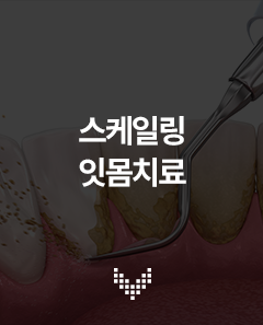 스케일링 잇몸치료