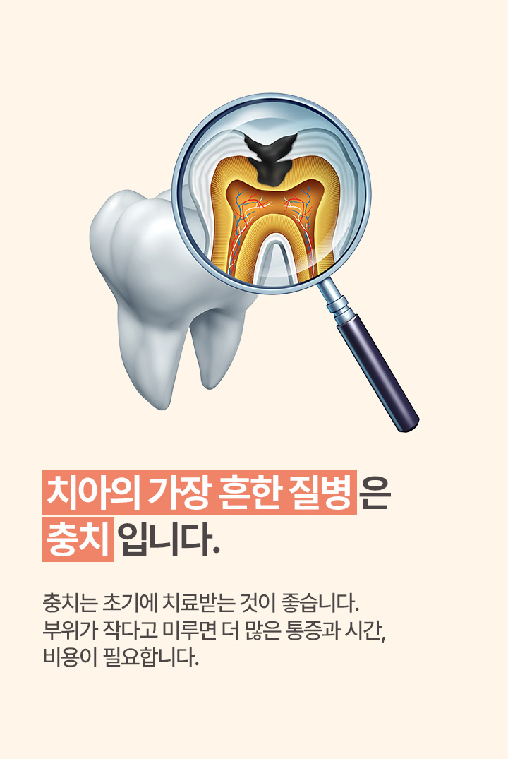 치아의 가장 흔한 질병은 충치입니다.