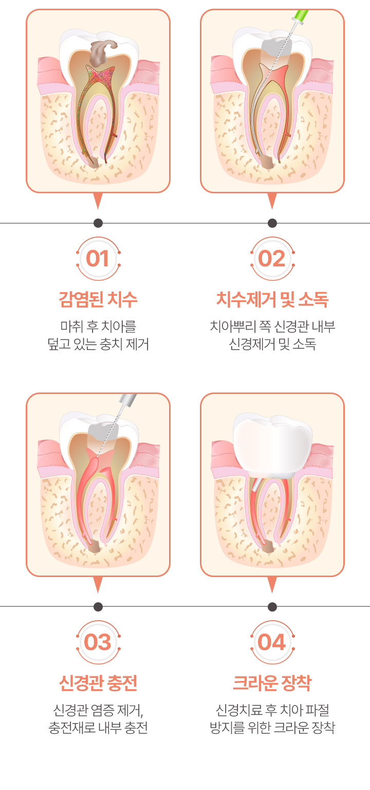 신경치료 단계